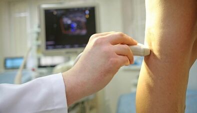 Lasersko liječenje varikoznih vena